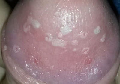 no sex girlfriend has yeast infection no sex girlfriend has yeast infection